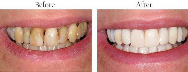 Mt. Kisco Before and After Dental Implants