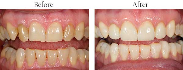 Katonah Before and After Teeth Whitening