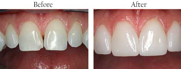 Mt. Kisco Before and After Dental Implants